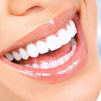 Clareamento Dental em Suzano