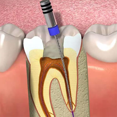 Endodontia em Suzano 