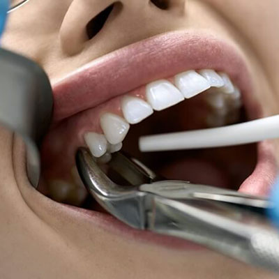Extração Dentária em Suzano