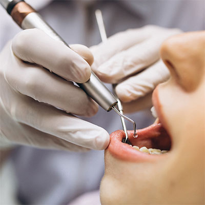 Implantes de Dentes em Suzano