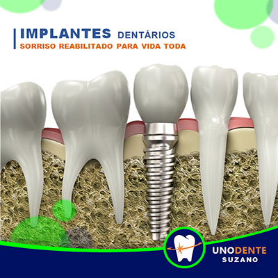 Implantes de Dentes em Suzano