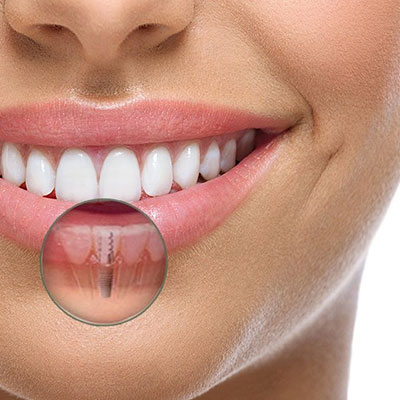 Implantes Dentários em Suzano
