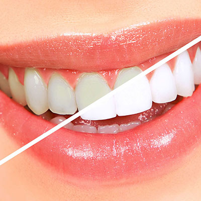 Estética - Clareamento Dental