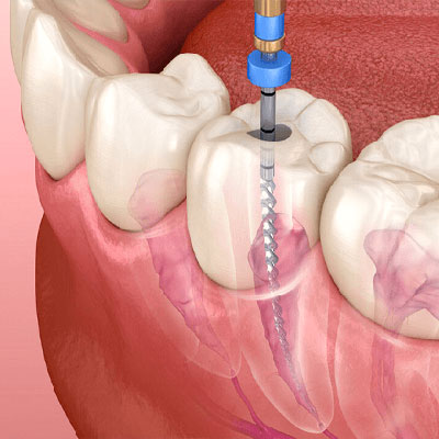 Tratamento de Endodontia em Suzano