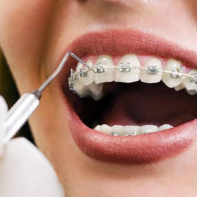Tratamento de Ortodontia em Suzano